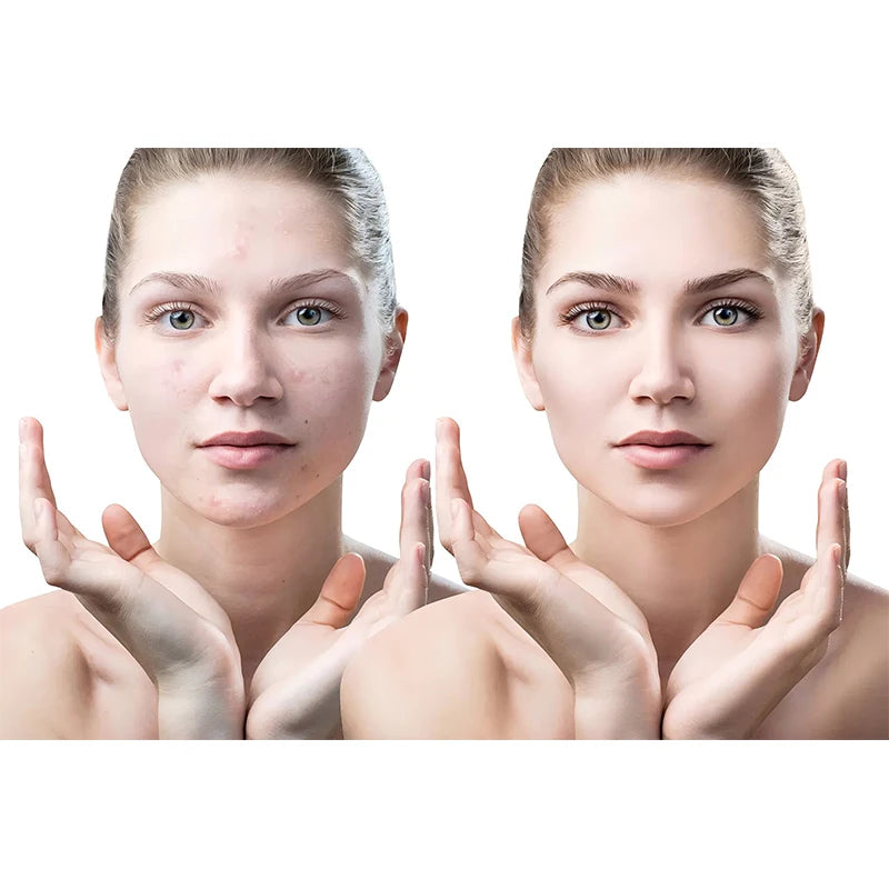 Anti Acne mesotherapy cocktail solution 5ml/vial