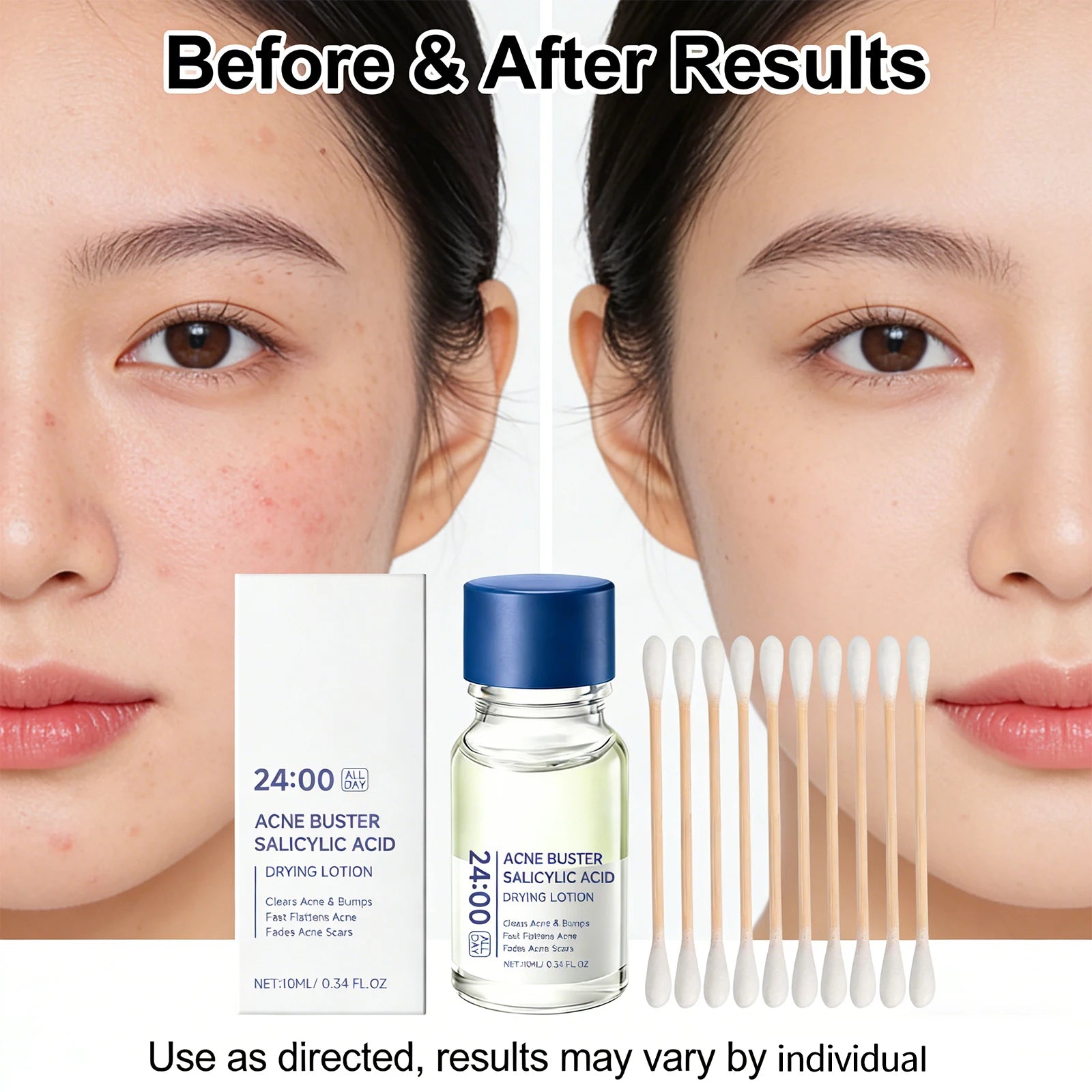 Salicylic Acid Drying Lotion Face Serum with Cotton Swab– Reduce Pimples & Breakouts Fade Acne Scars Minimize Pores Skin Renewal